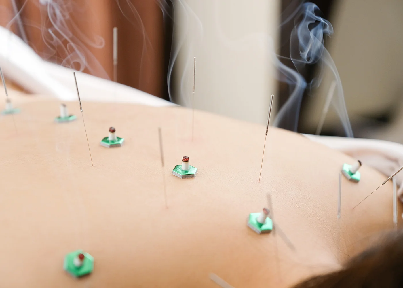 つづき接骨院・鍼灸院の選ばれる理由は接骨と鍼灸を組み合わせた施術